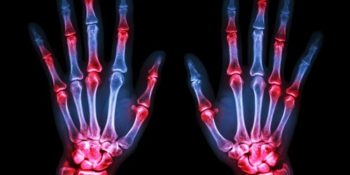 3 Tips for Individuals With Arthritis