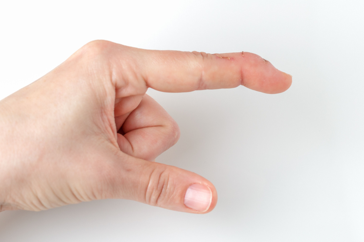A person showing their mallet finger
