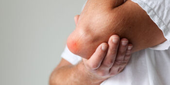 What Does Elbow Bursitis Look & Feel Like?