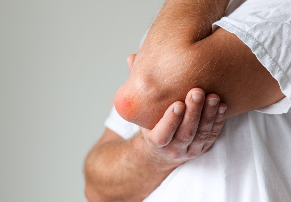 A man's elbow that is red and swollen due to bursitis
