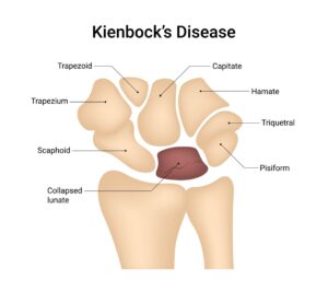 An illustration highlighting a collapsed lunate bone in the wrist (which shows the cause of Kienbock's disease)