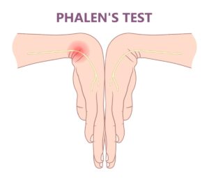 An illustration of two hands performing the Phalen's test - the backs of the hands are pressed together