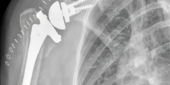 Your Introduction to Reverse Shoulder Replacement